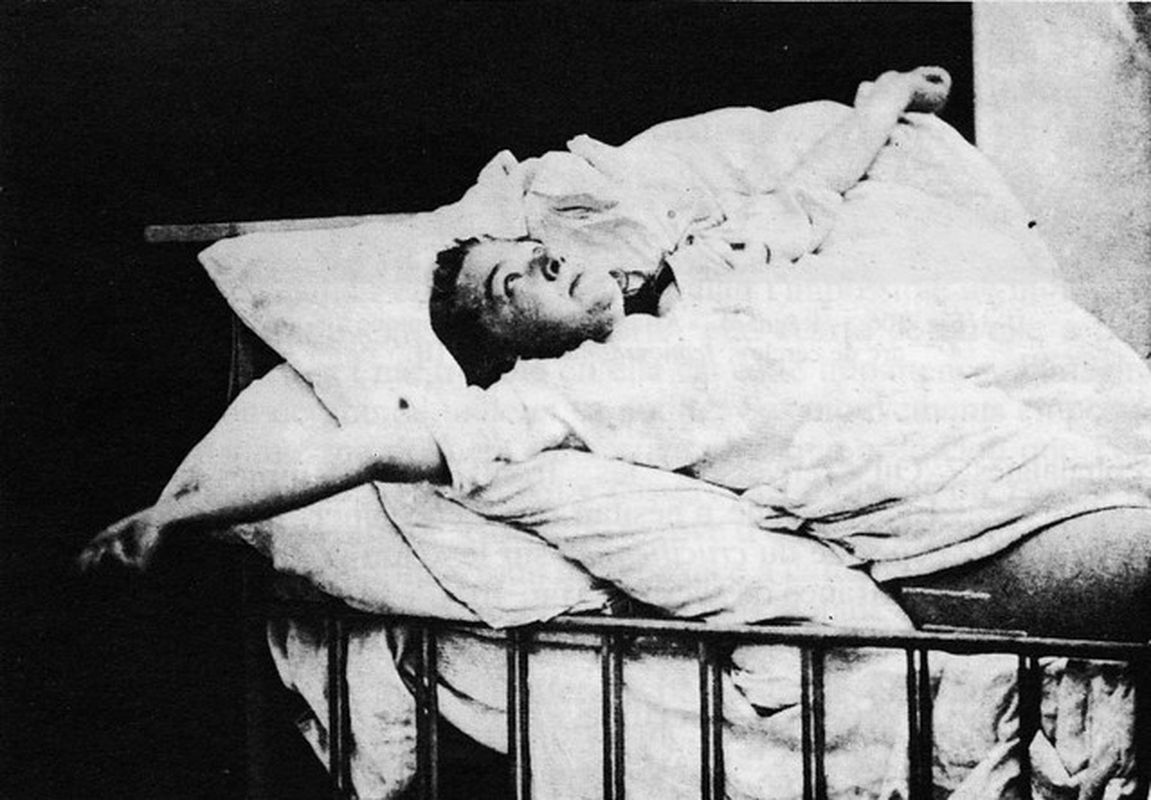 İnsanları Uykunun İçinde Hapseden, Tıp Tarihinin En Gizemli Hastalığı; Ensefalit Lethargica